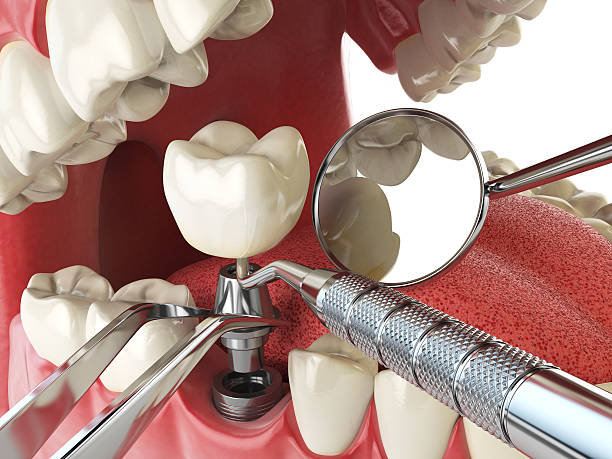 Best Emergency Denture Repair in Speedway, IN
